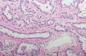 Micrograph of Pleural Mesothelioma with tubule/papillary pattern.