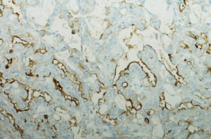 Micrograph of Pleural Mesothelioma. D2-40 immunostain