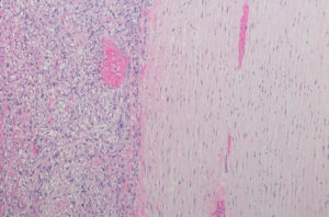 Micrograph of Sarcomatoid Mesothelioma involving pulmonary artery wall.