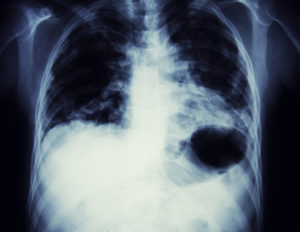 chest xray depicting lung cancer