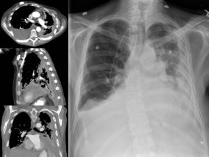 chest xray and ct scans showing mesothelioma