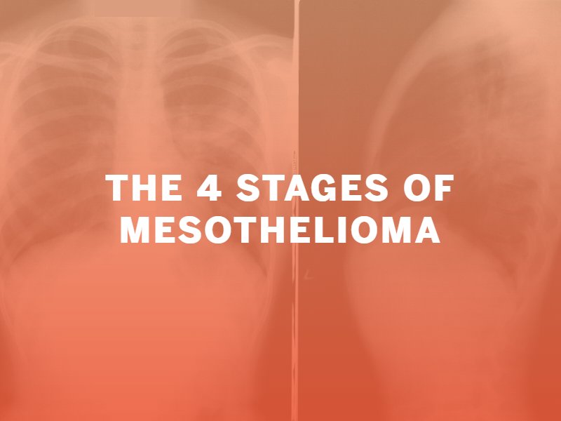 4 stages of Mesothelioma